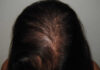 Remedios caseros para la caída del pelo